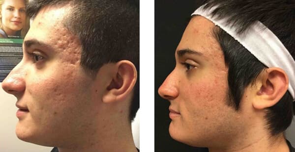 VISIA Skin Analysis + Touchless Laser Rejuvenation result at Khrom Dermatology & Aesthetics