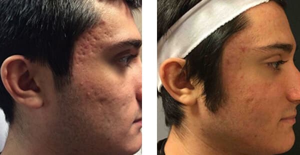 VISIA Skin Analysis + Touchless Laser Rejuvenation result at Khrom Dermatology & Aesthetics