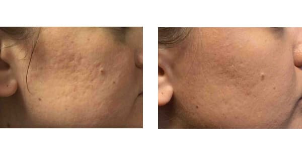 VISIA Skin Analysis + Touchless Laser Rejuvenation result at Khrom Dermatology & Aesthetics