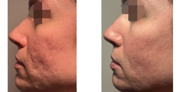 VISIA Skin Analysis + LaseMD Laser result at Khrom Dermatology & Aesthetics