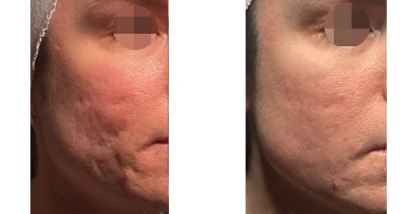 VISIA Skin Analysis + Touchless Laser Rejuvenation result at Khrom Dermatology & Aesthetics