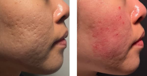 VISIA Skin Analysis + Touchless Laser Rejuvenation result at Khrom Dermatology & Aesthetics